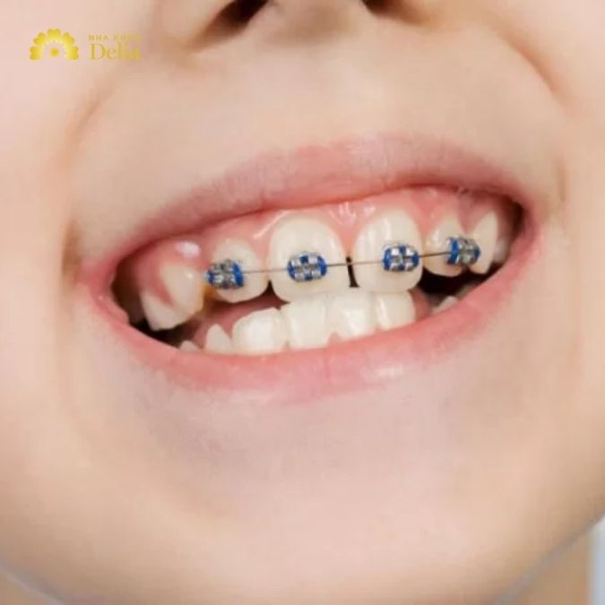 12 tuổi niềng răng bao nhiêu tiền? Cập nhật bảng giá mới nhất