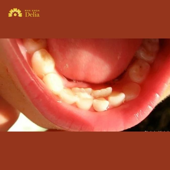Răng vĩnh viễn mọc lệch vào trong phải làm sao? Bác sĩ giải đáp