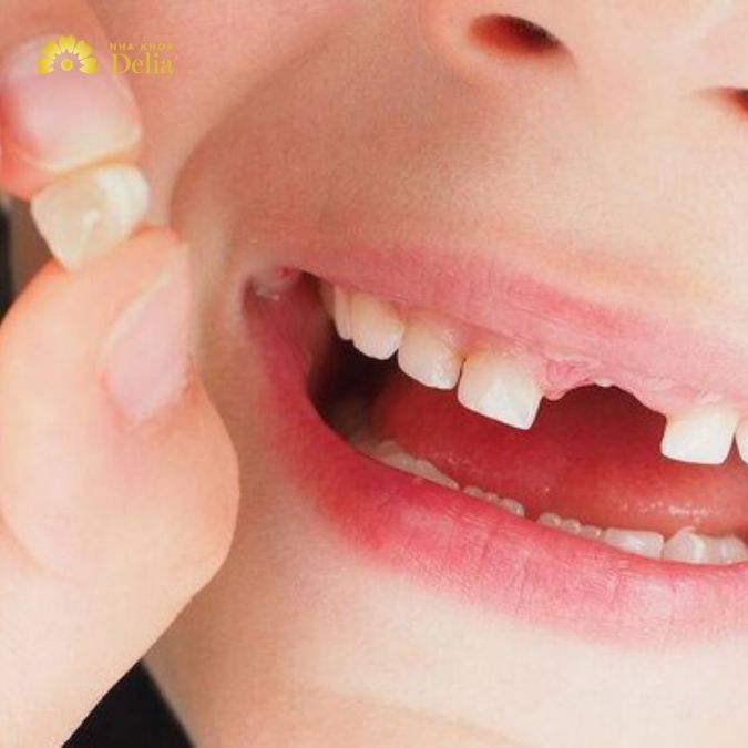 Thứ tự rụng răng sữa ở trẻ bắt đầu từ răng nào sớm nhất?