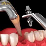 Trồng răng Implant tức thì nhanh nhất ở đâu đảm bảo chất lượng?