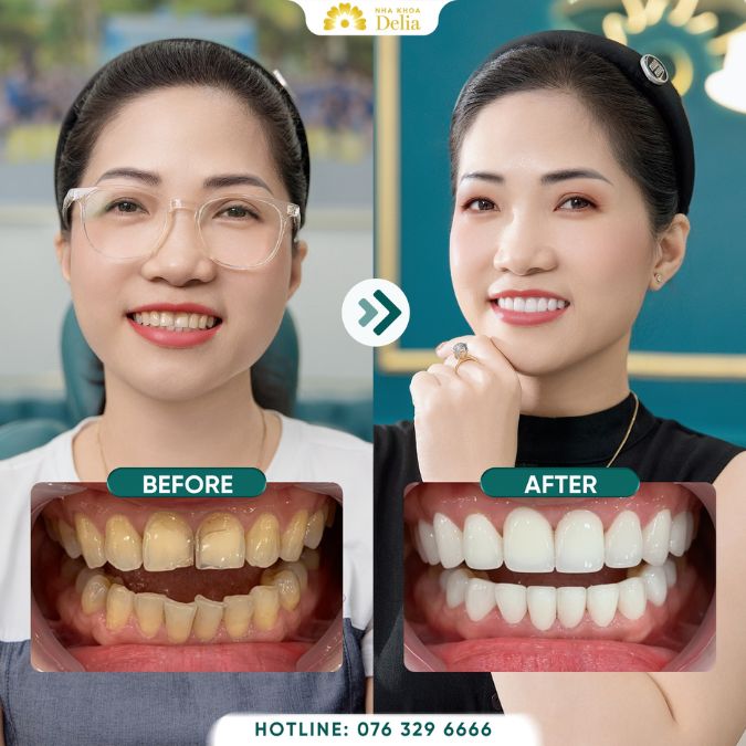 27 tuổi còn niềng răng được không? Có hiệu quả cao không?