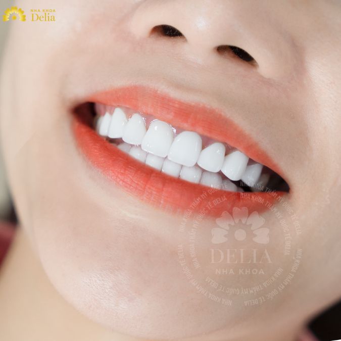 Khám phá những dòng răng sứ cao cấp tại nha khoa Delia
