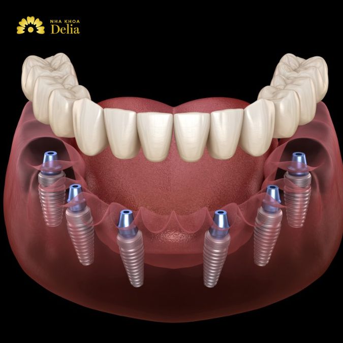 What is the all in one Implants technique and is it good?