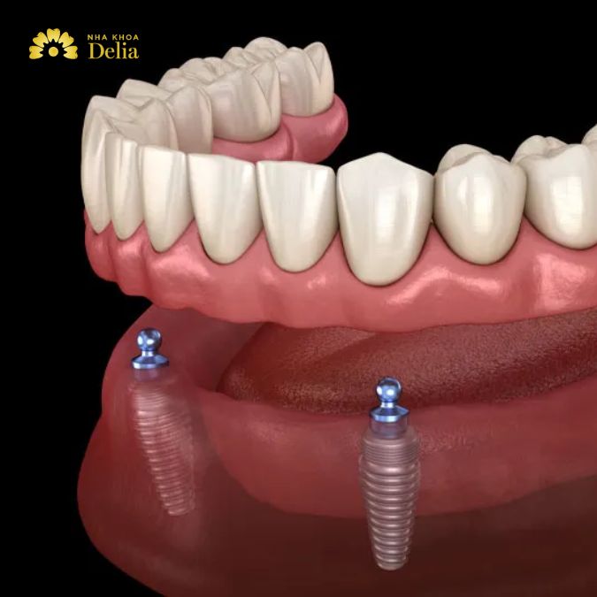 What are all on 2 dental implants and are they good?