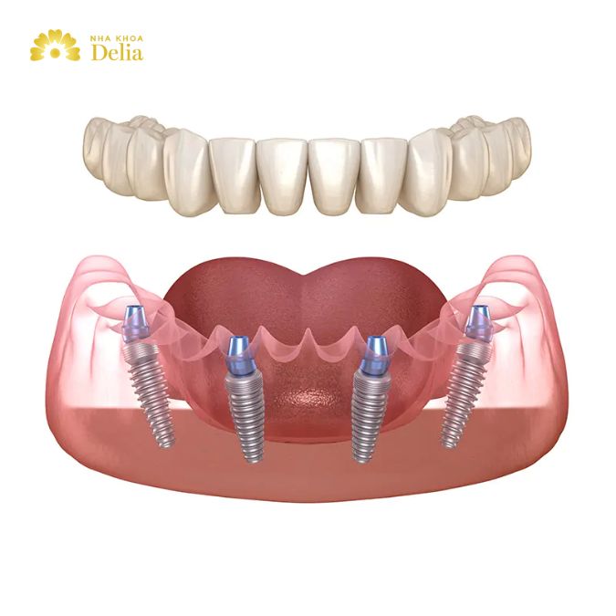 All on 4 dental implants cost with insurance: what you need to know