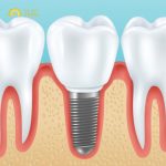 Trồng răng Implant tức thì là quá trình cấy ghép răng nhân tạo vào xương hàm mà không cần chờ đợi giai đoạn tích hợp xương truyền thống
