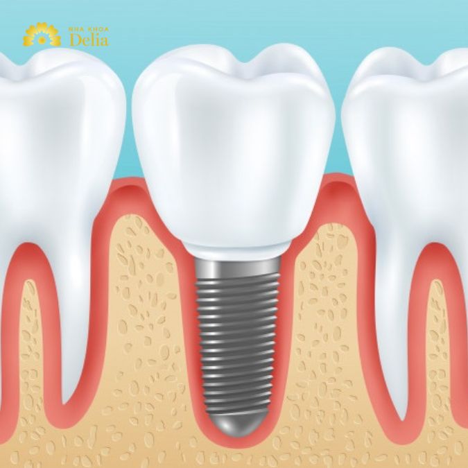 All on 8 dental Implants: Ultimate solution for smiles