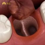 Hướng dẫn cách vệ sinh lỗ răng khôn sau khi nhổ chi tiết nhất