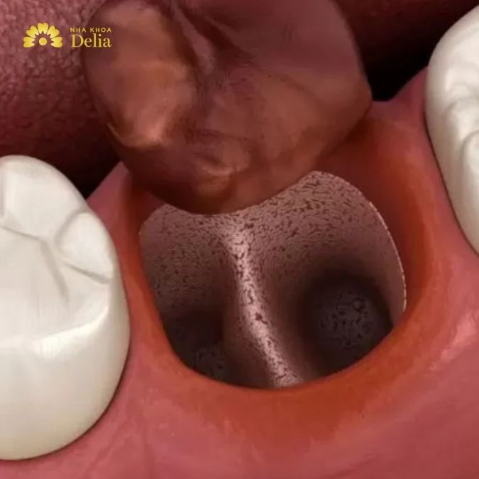 Nhổ răng cấm có đau không, khi nào nên nhổ răng cấm?