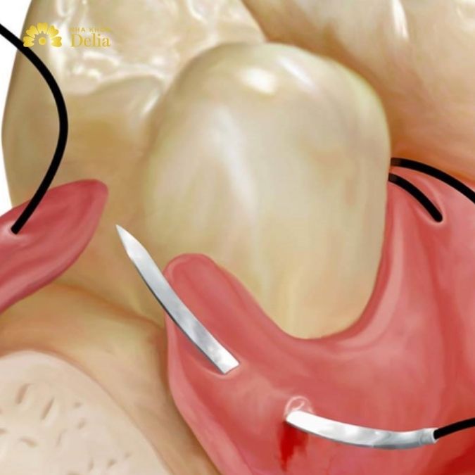 Tổng hợp thông tin cần biết về cắt chỉ răng khôn