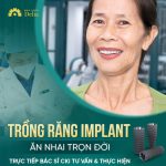 Hành trình cải thiện cuộc sống với răng Implant của cô Kim Nở