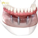 Where is cheapest country for all-on-4 dental implants?