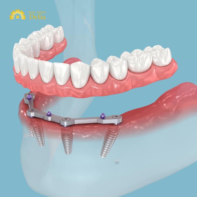 Bone loss around dental implant: Causes, symptoms and solutions