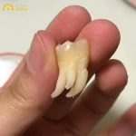 Tại sao nhiều người muốn giữ lại răng sau khi nhổ?