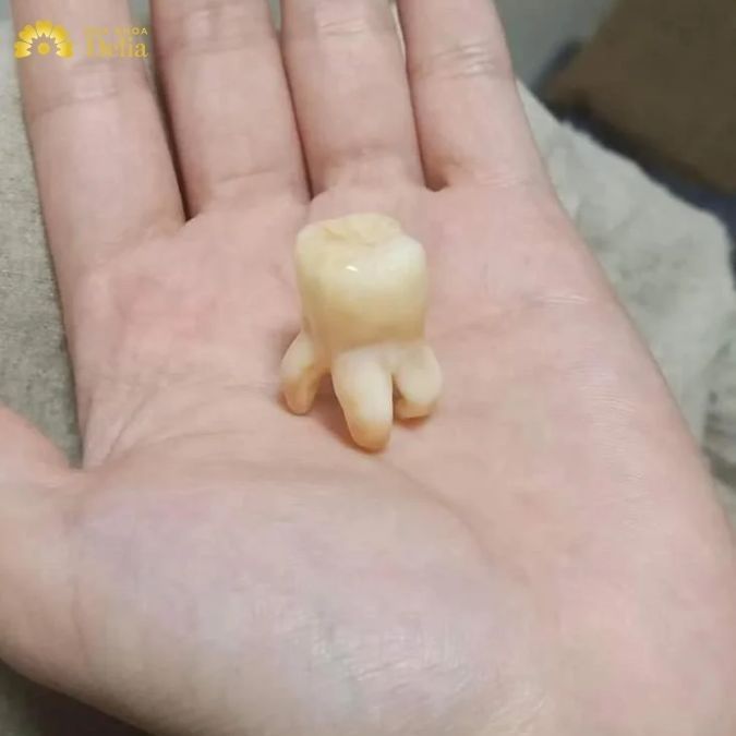 Nhổ răng cấm có nguy hiểm không? Khi nào nên nhổ răng cấm