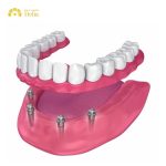 Understanding Immediate all on 4 dental implants