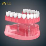 What are immediate all on 4 dental Implants?