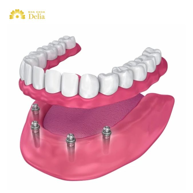 Pros and cons of all on 4 dental implants: What you should know