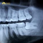 Làm sao để biết răng khôn mọc thẳng, dấu hiệu chính xác nhất