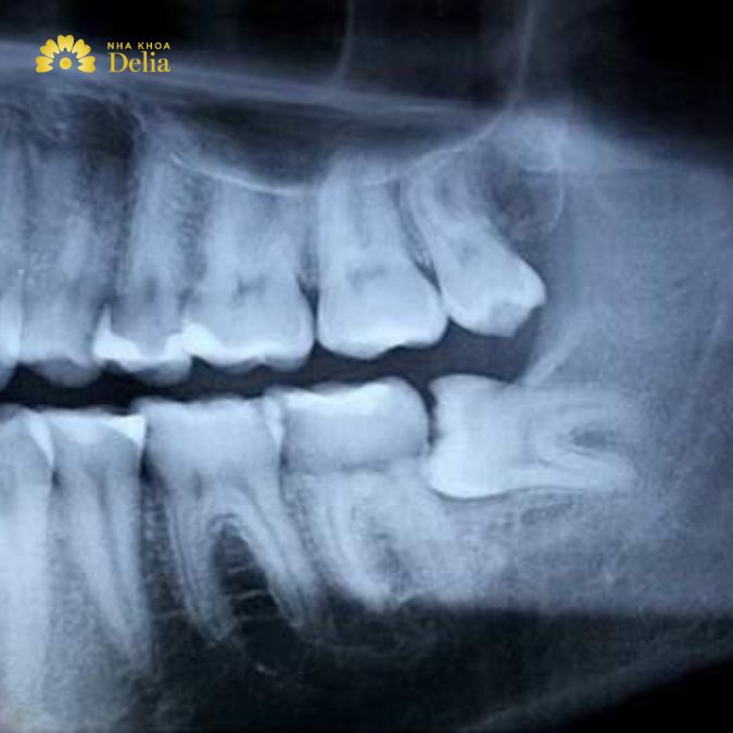 Làm sao để biết răng khôn mọc thẳng, dấu hiệu chính xác nhất