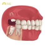 Mọc răng khôn đau mấy ngày thì hết? Bác sĩ giải đáp