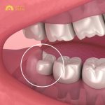Giải đáp thắc mắc: Răng khôn có mấy cái? Mọc khi nào?
