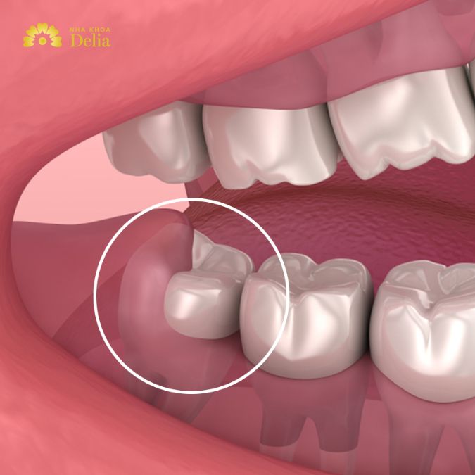 Giải đáp thắc mắc: Răng khôn có mấy cái? Mọc khi nào?