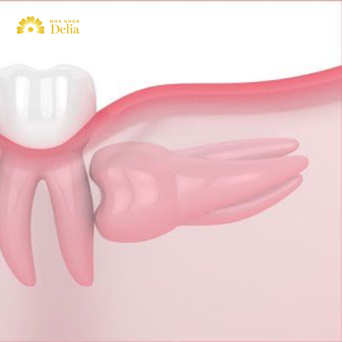 Răng khôn mọc ngang có ảnh hưởng gì không, cần làm gì?