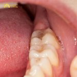 Sưng nướu răng khôn là như thế nào, điều trị ra sao?