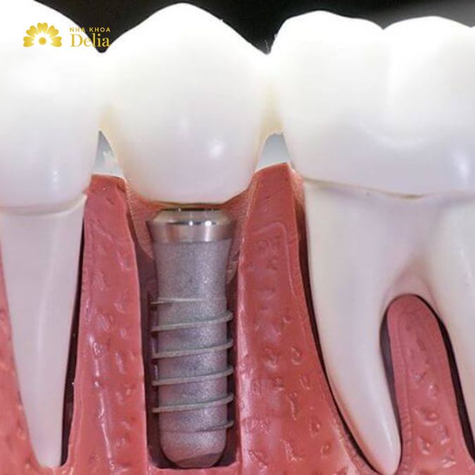 Trồng răng implant bây giờ có kịp ăn Tết không, trồng hết bao lâu?