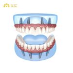 What is all on 4 dental implants? What you need to know?