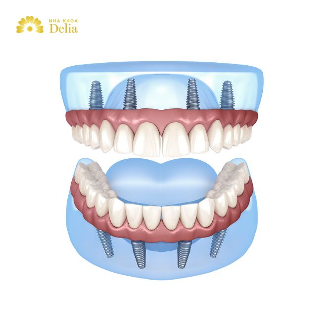 What is all on 4 dental implants? What you need to know?