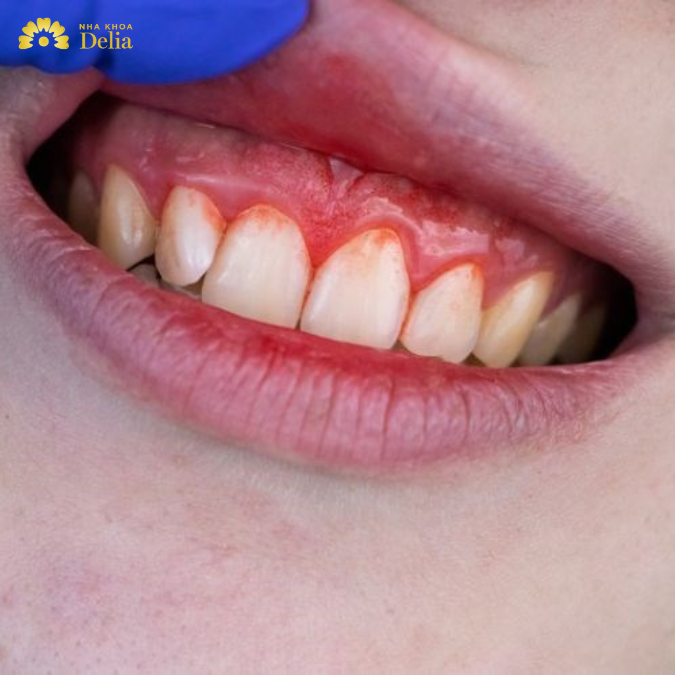 Liệu đánh răng nhiều có bị mòn không? – Đánh răng như nào cho đúng?