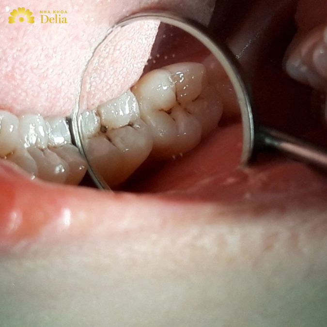 Trả lời: Sâu răng nhẹ đánh răng có hết không?