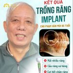 Niềm vui mới của chú Mùi nhờ trồng răng Implant tại Delia