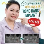 Cô giáo miền núi vượt 250km để trồng răng Implant và cái kết