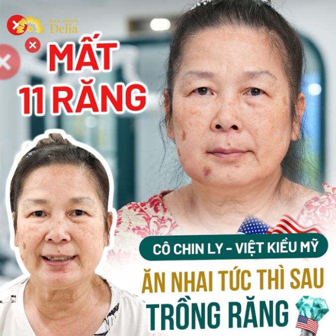 Mất 11 răng – Ăn nhai tức thì sau trồng răng Implant – Cô Chin Ly Việt Kiều Mỹ