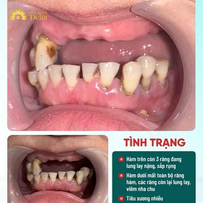 Dental Implants Thailand reviews: Top choices for you