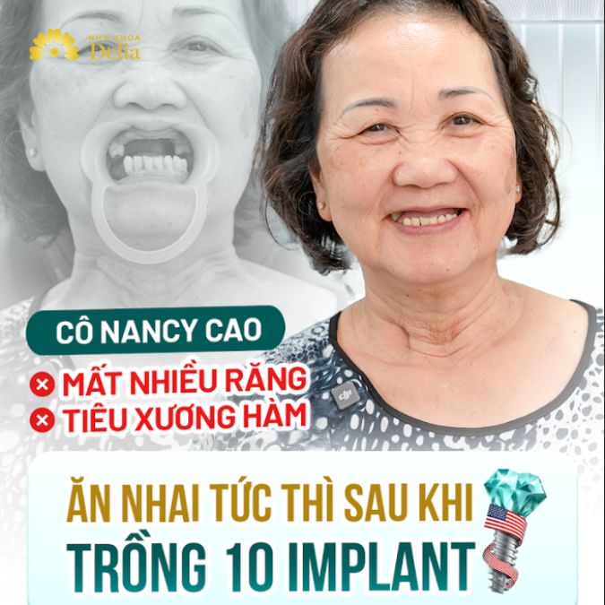 Cô Nancy Cao VK Mỹ  trồng 10 trụ Implant cùng lúc liệu có khả thi