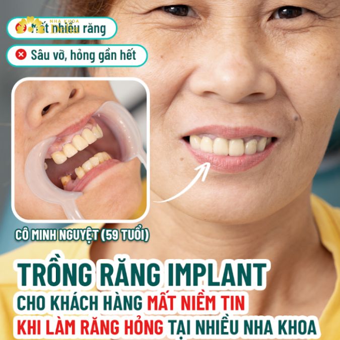 Mất răng nghiêm trọng nhiều năm liệu có trồng Implant được không? – KH Minh Nguyệt