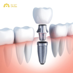 Cấy ghép răng Implant được thực hiện trong trường hợp răng cấm bị mất hoàn toàn
