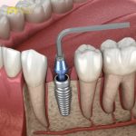 What is immediate dental implants placement? How much does it cost?