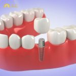 Benefits of Immediate Dental Implants