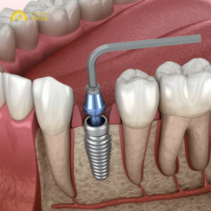 Benefits of Zirconia implants: A strong, aesthetic dental solution