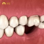 Mất răng nhai có nghiêm trọng không, cần phải làm gì?