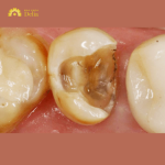 Răng cấm bị bể phải làm sao, điều trị như thế nào?