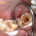Răng cấm bị sâu phải làm sao? Có nhổ răng cấm được không?
