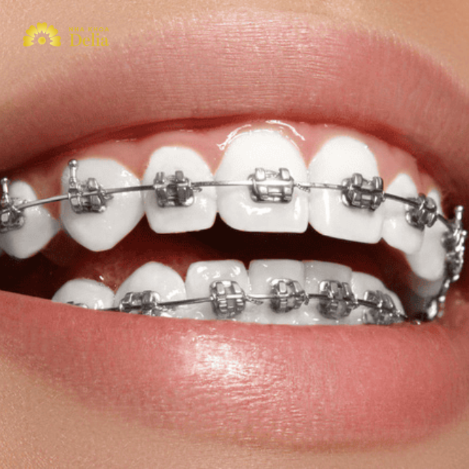 19 tuổi niềng răng bao nhiêu tiền, có hiệu quả cao không?