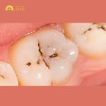 Răng nhai bị đen: Nguyên nhân và cách xử lý chi tiết nhất