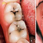 Khi răng bị sâu, phần men răng bị phá hủy và tạo thành các vết đen hoặc lỗ hổng trên bề mặt răng